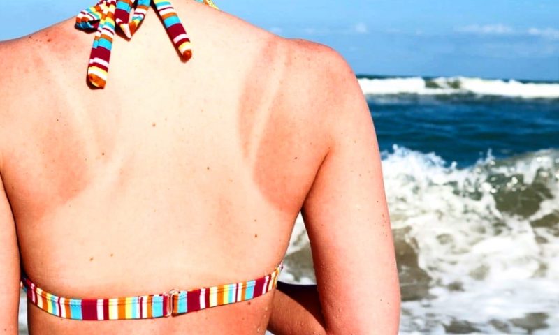 Deal With a Sunburn While on Vacation